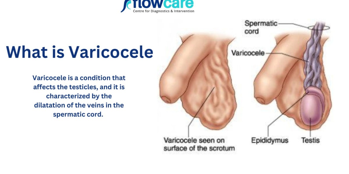 Understanding Varicocele Symptoms: A Comprehensive Guide