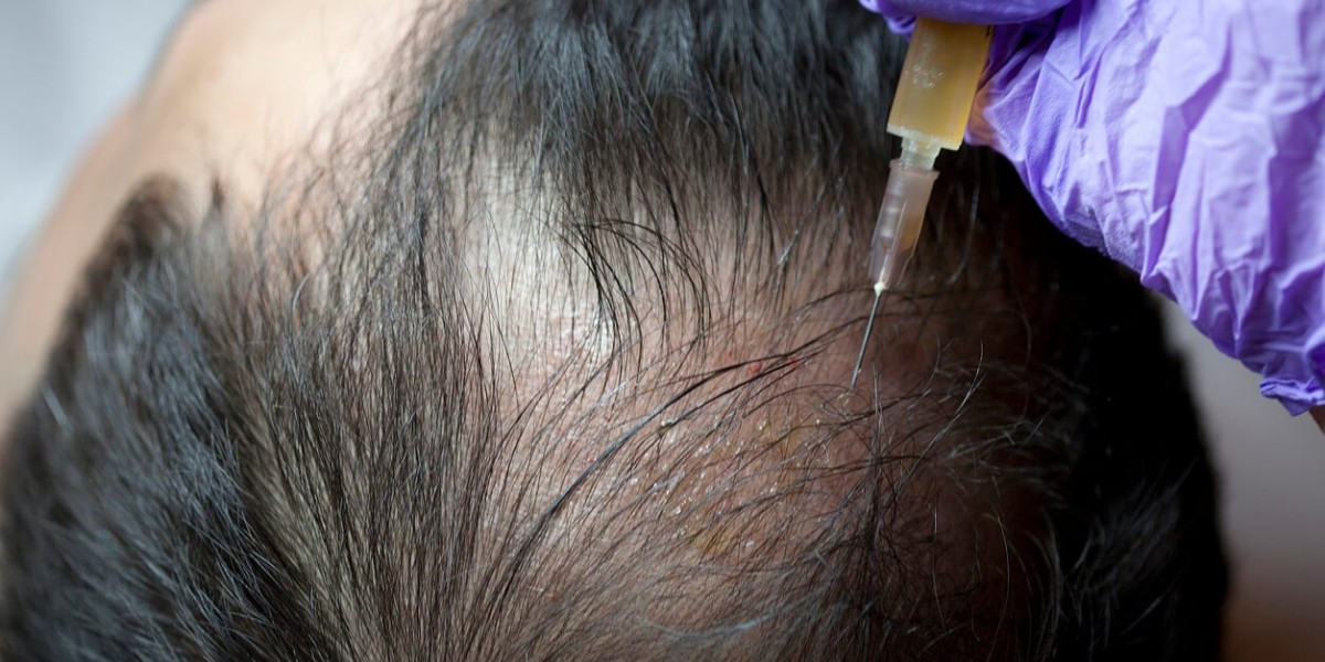 PRP Therapy for Hair Growth: What You Need to Know Before Starting