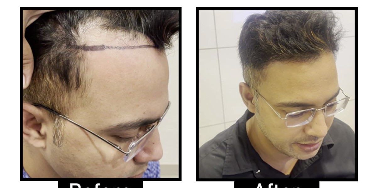 Best Hair Transplant in Delhi: Costs, Techniques, and Clinics